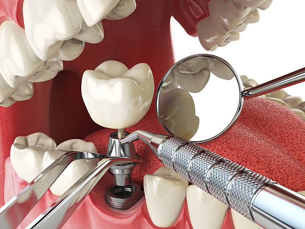 Best Emergency Root Canal Treatment in Oildale, CA